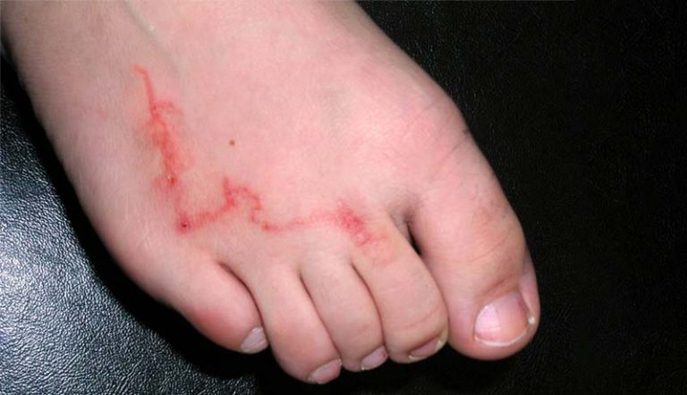Sector Salud atento a enfermedades parasitarias transmitidas por