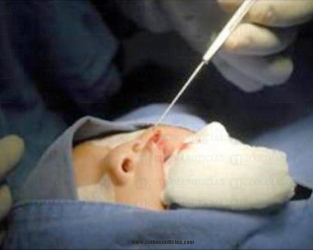 operacion labio hendido