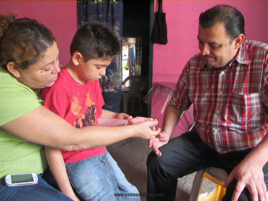niño QUE SE RECUPERO DE QUEMADURA