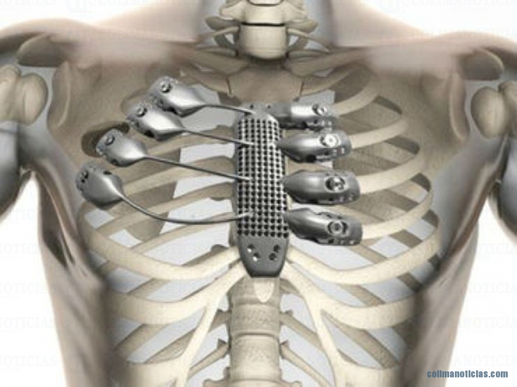 Médicos implantan con éxito las primeras costillas impresas en 3D