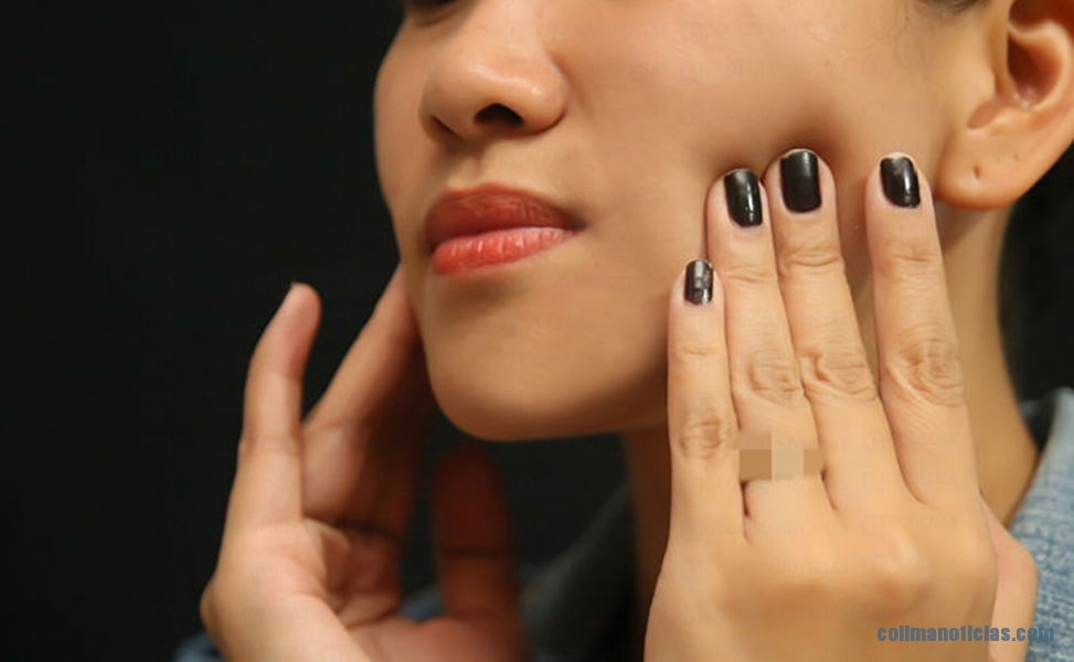 MUJER PARALISIS FACIAL