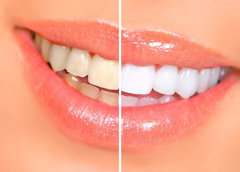 Recupera el blanco natural de tus dientes