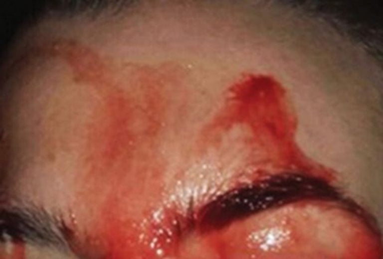 Médicos italianos intrigados por joven que suda sangre