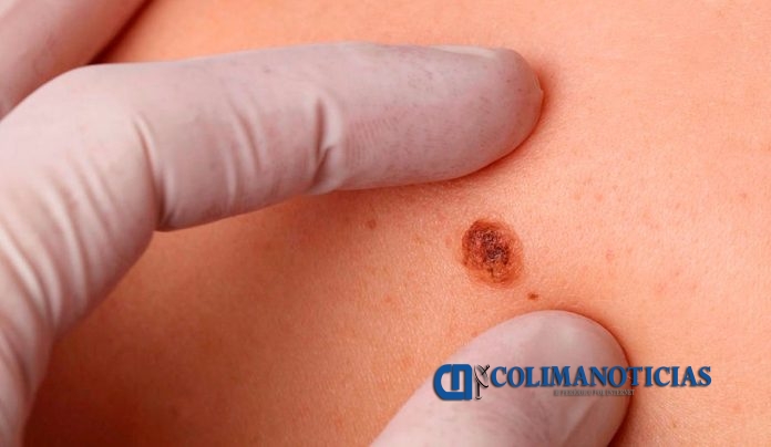 Cáncer de piel