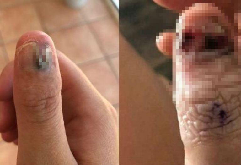 Joven australiana pierde un dedo por el hábito de morderse las uñas