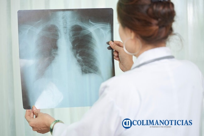 tuberculosis