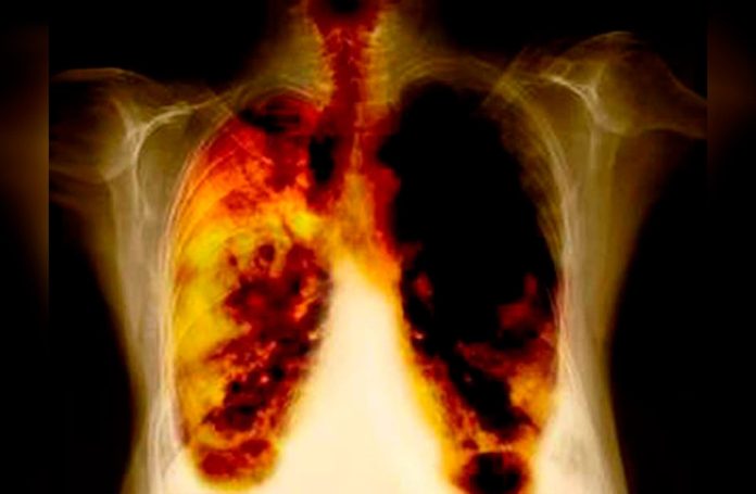 cancer de pulmon