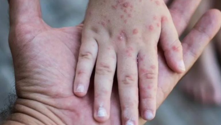 Muere niño por complicaciones asociadas a sarampión en Tlaxcala